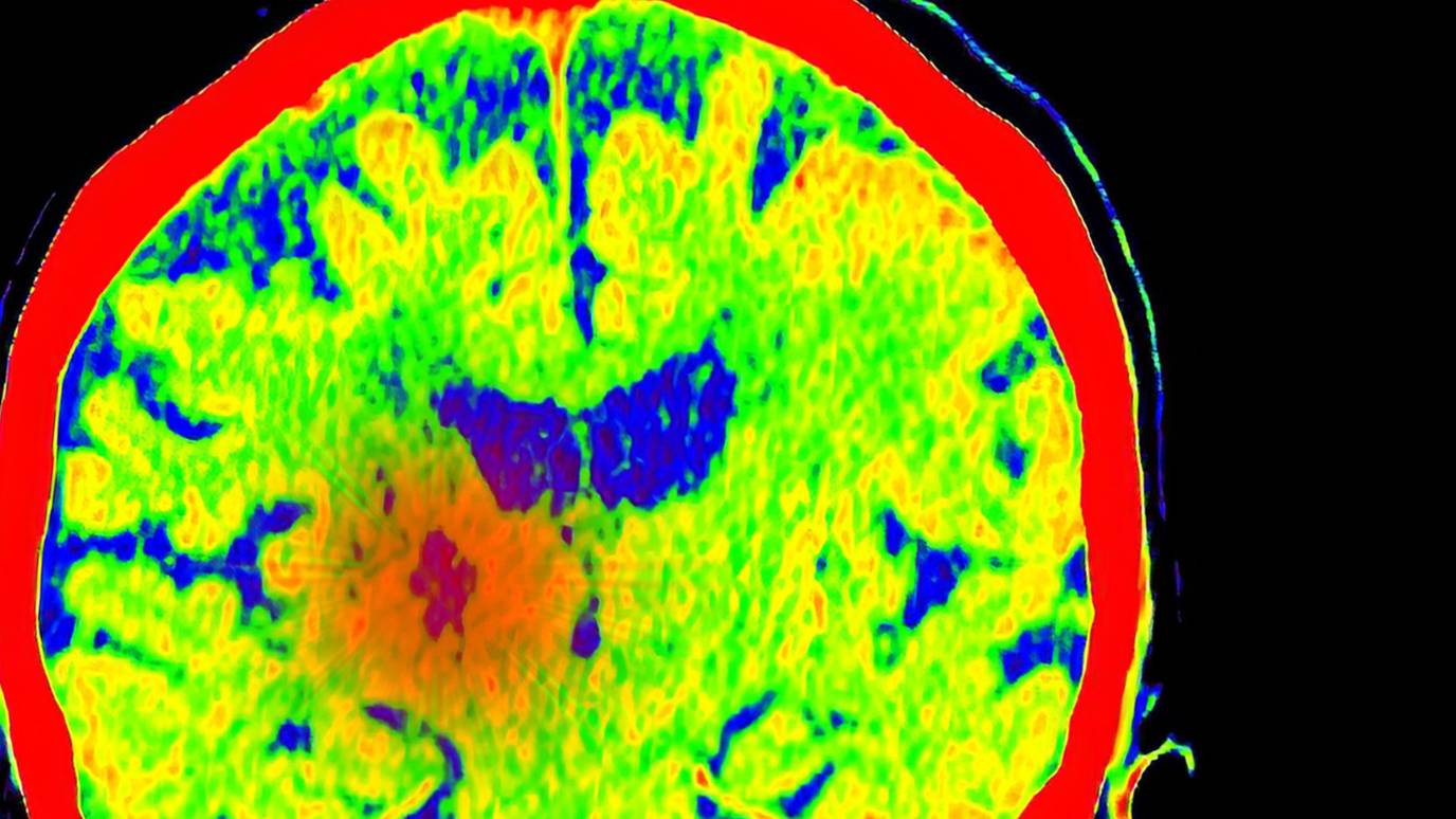 New Glioblastoma Treatment Reaches Human Brain Tumor and Helps Immune ...